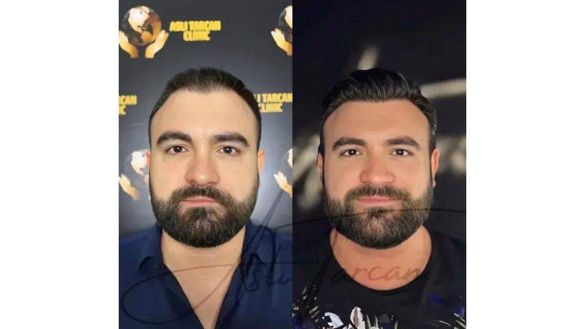 Turkish Hair Transplant Package and U.S. Hair Transplant Costs