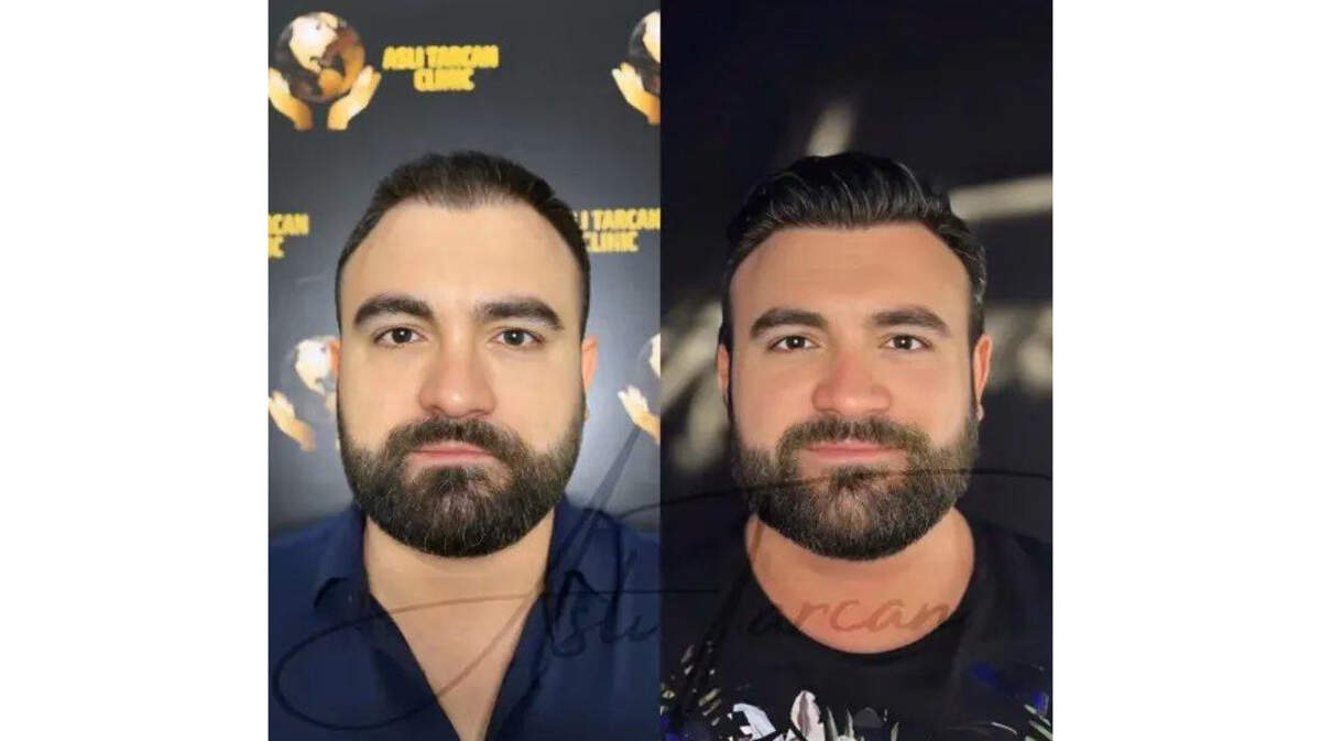 Turkish Hair Transplant