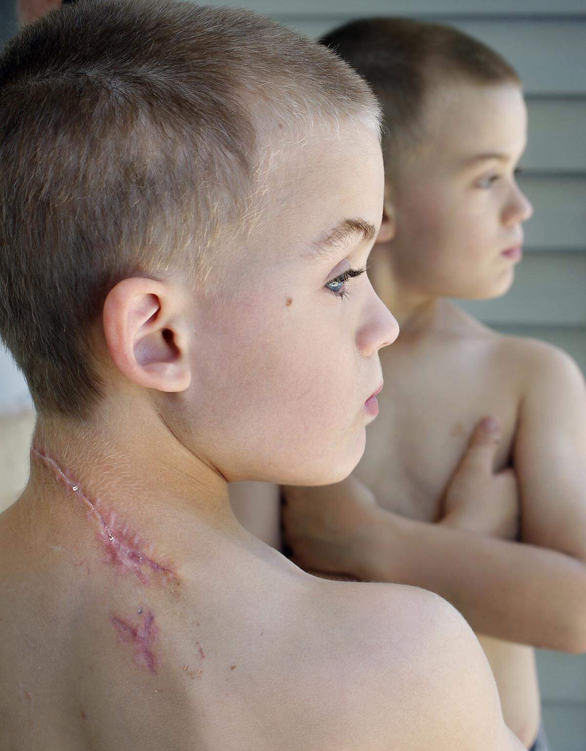 The vertebrae in 6-year-old Brody German’s neck were showing through his wound after the tornado passed though Joplin. 