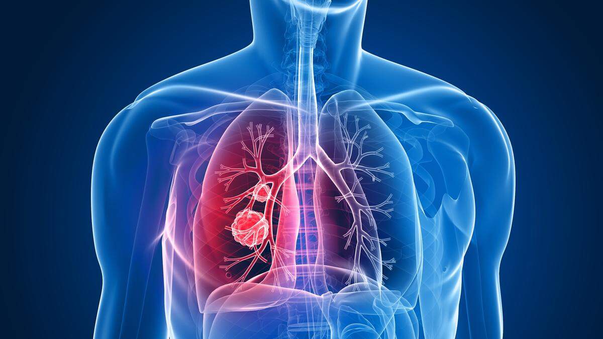 3D-rendered X-ray illustration of a tumor in a lung.