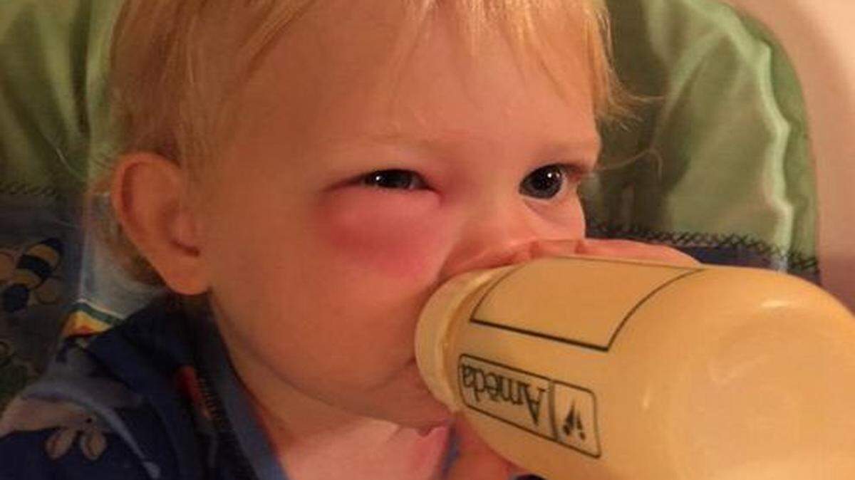 About a week ago, Stephen Koranda’s 16-month-old daughter, Elise, developed a scary-looking welt under one eye.
