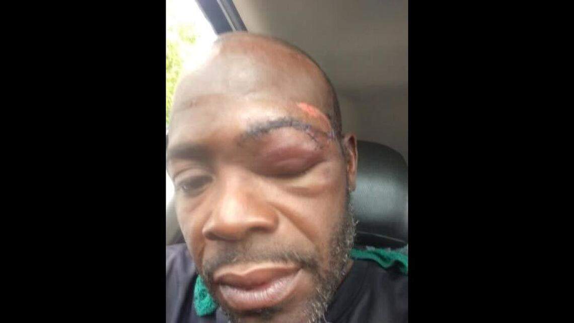 Mack Nelson, 44, shows his injuries after he was thrown to the ground at the scene of a police shooting.