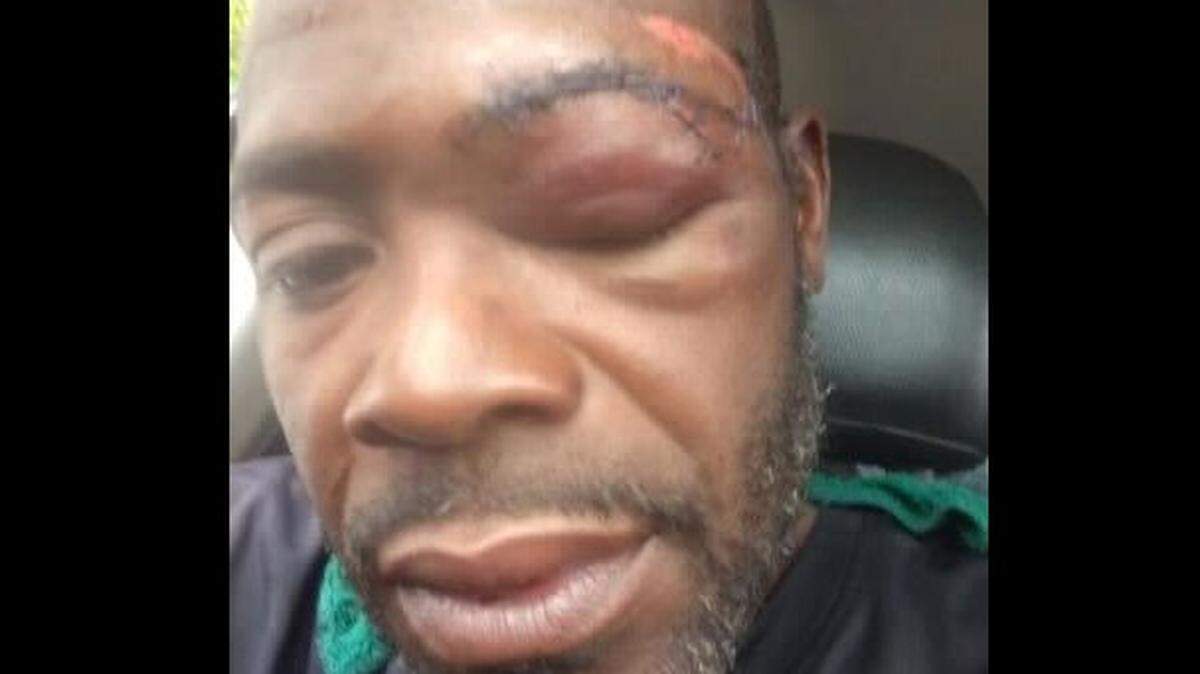 Mack Nelson shows his injuries after he was thrown to the ground at the scene of a 2022 police shooting in Kansas City.
