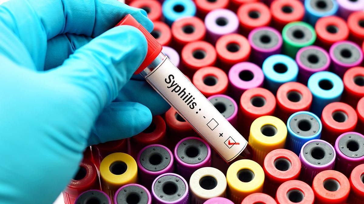 Blood sample with syphilis (Treponema Pallidum) positive