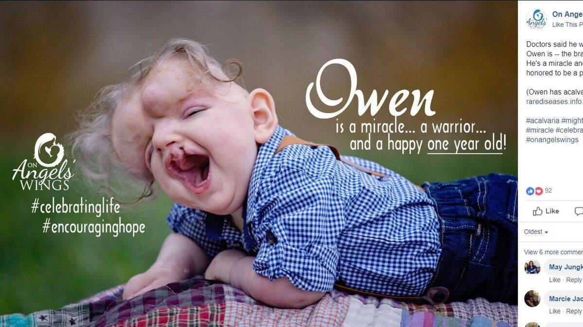 Owen Masterson, of Missouri, celebrated his first birthday in September after he was diagnosed with Acalvaria, a rare and fatal condition.