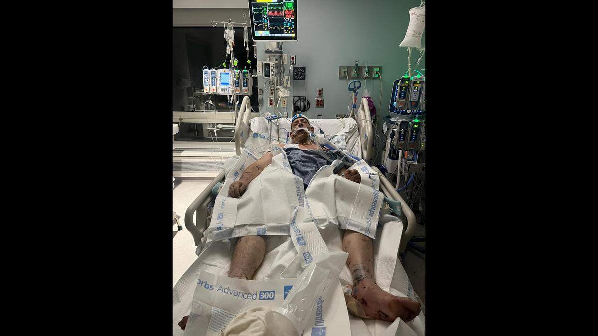 A photo of Chris Culbertson in the hospital after he was attacked by a pack of dogs.