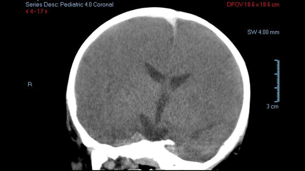 the whiteish, cotton-like V at the top of the scan is the subdural hematoma.  This is what Mitchell said was "massive."  Our experts said this would not be fatal and was likely caused by reprofusion, when oxygen was restored to Jonathan's brain. 