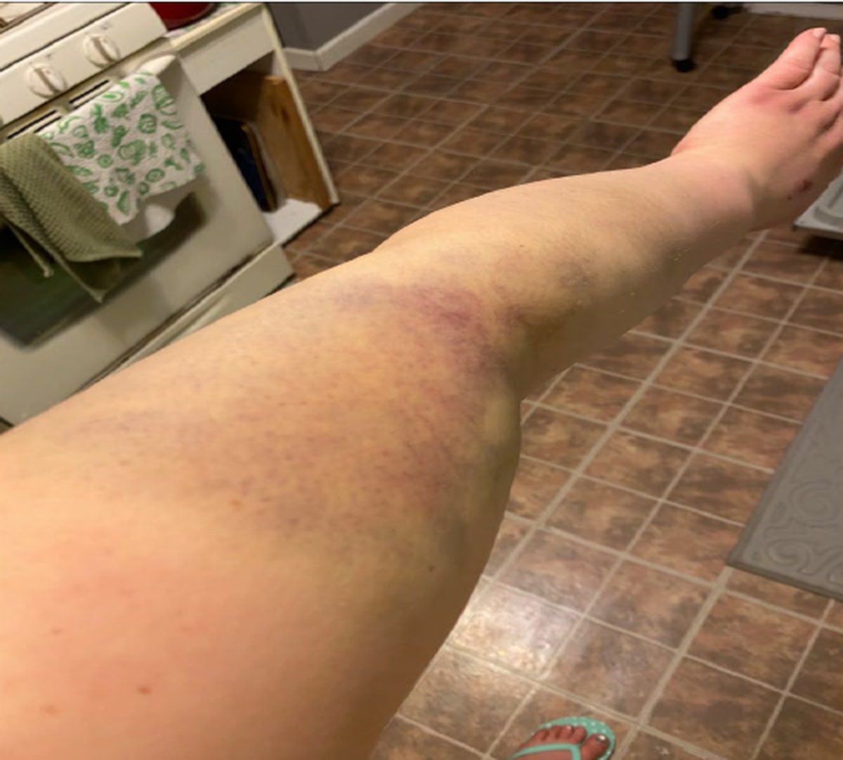 Patty Day said her arms were bruised as a result of excessive force used by Derek Chauvin and Ellen Jensen, according to a federal lawsuit filed May 21.