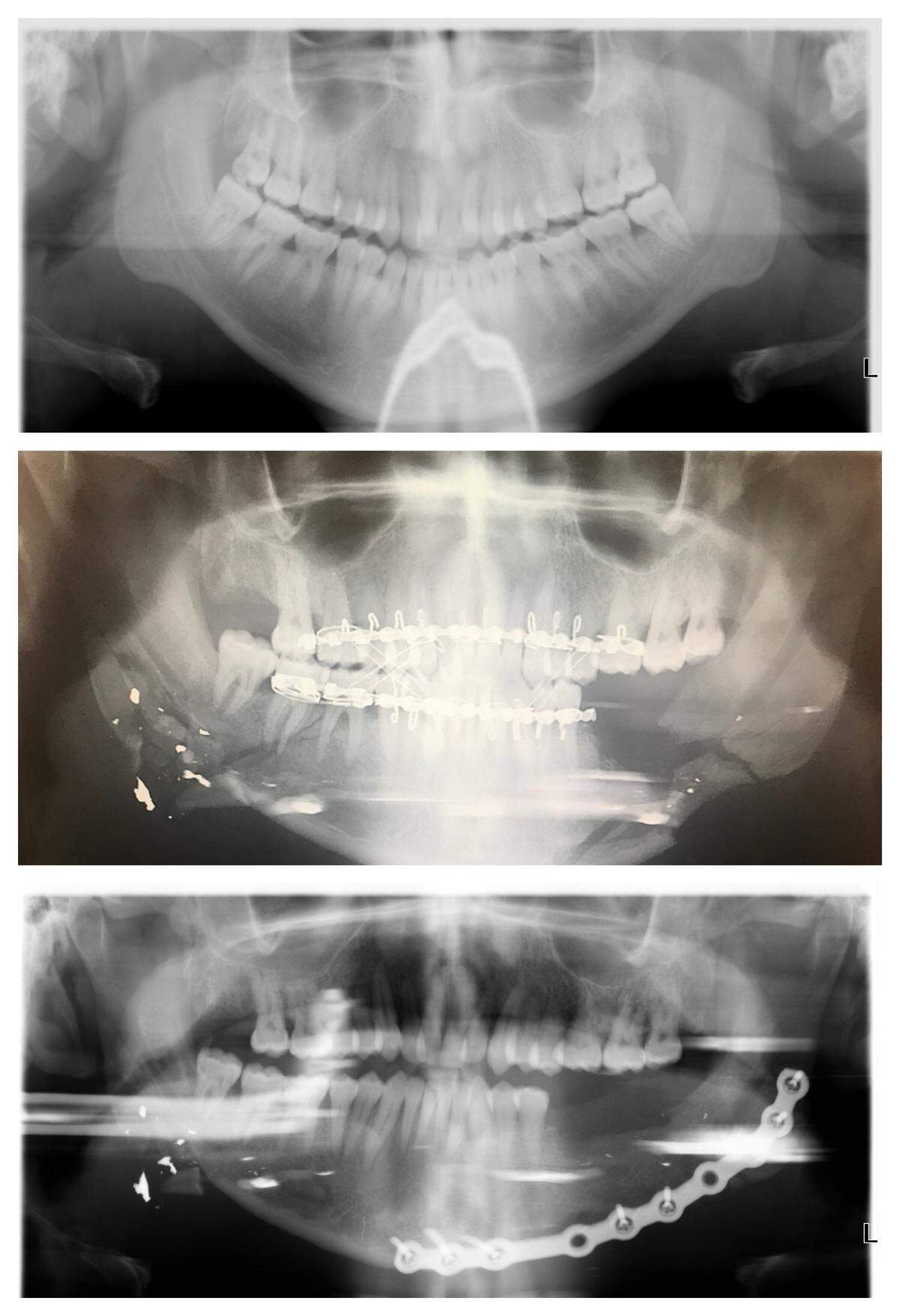 Antoine Roston was shot through his mouth Oct. 29. The first X-ray, top, was taken before the shooting. The middle X-ray shows the shattered jaw bones and missing teeth after the bullet passed left-to-right in the image (from the right cheek to the left for the victim). The bottom X-ray shows the repaired jaw with a metal plate.