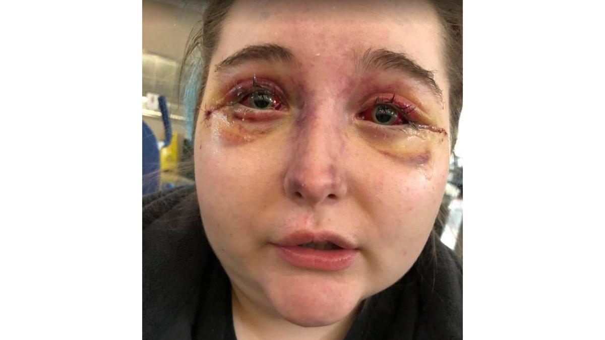 As Jordyn Walker’s face swelled, surgeons had to cut away at the orbital bones that cup each eye, giving the eyeballs room to expand. The question was whether even this was too little, too late.