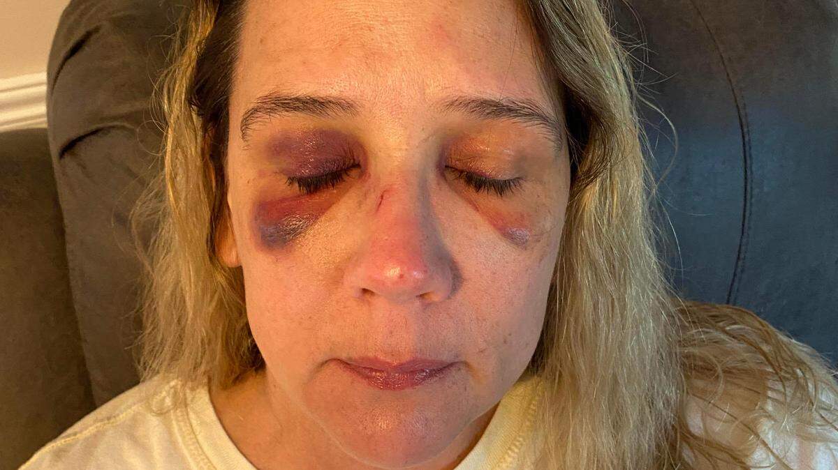 Michelle Audo of Blue Springs took this photo two days after she says two teenage girls assaulted her in her driveway. She said she was later diagnosed with a concussion and a fractured nose.
