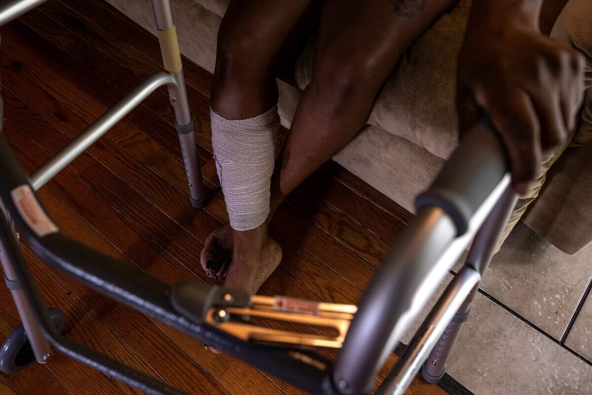 Shawanna Simms shows a wound while being photographed at her home on Thursday, June 18, 2026, in Kansas City. She was injured in a shooting spree along Interstate 70 on Tuesday night.