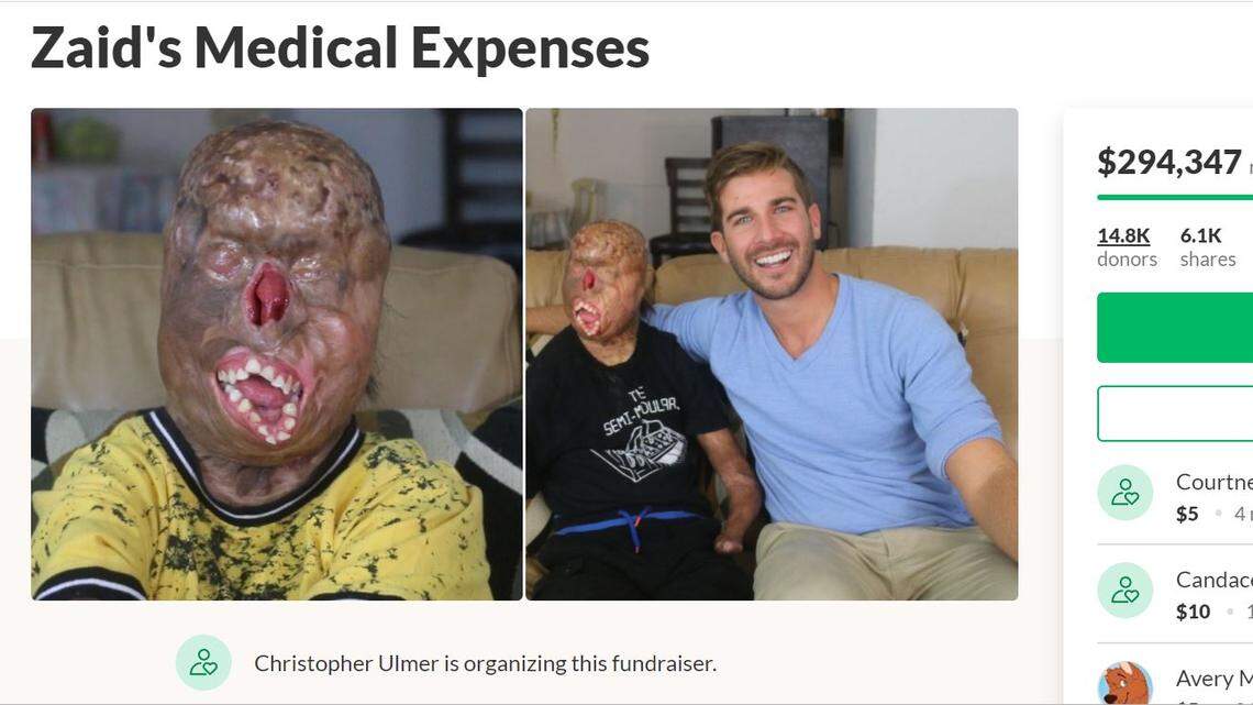 Story of Zaid, disfigured by burns at age 2, has brought in some $300,000 in GoFundMe donations in only days, including $5,000 from actor Jared Leto