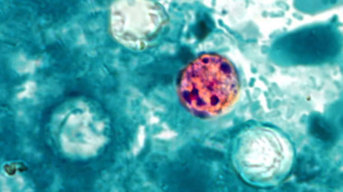 How many Cyclospora cases are in Kansas City? See numbers for 5 counties