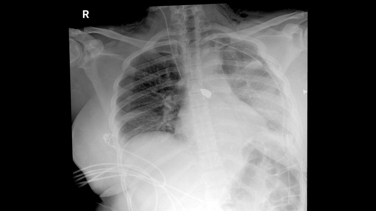 Brandi Fields still has a bullet lodged in her spine from the shooting.