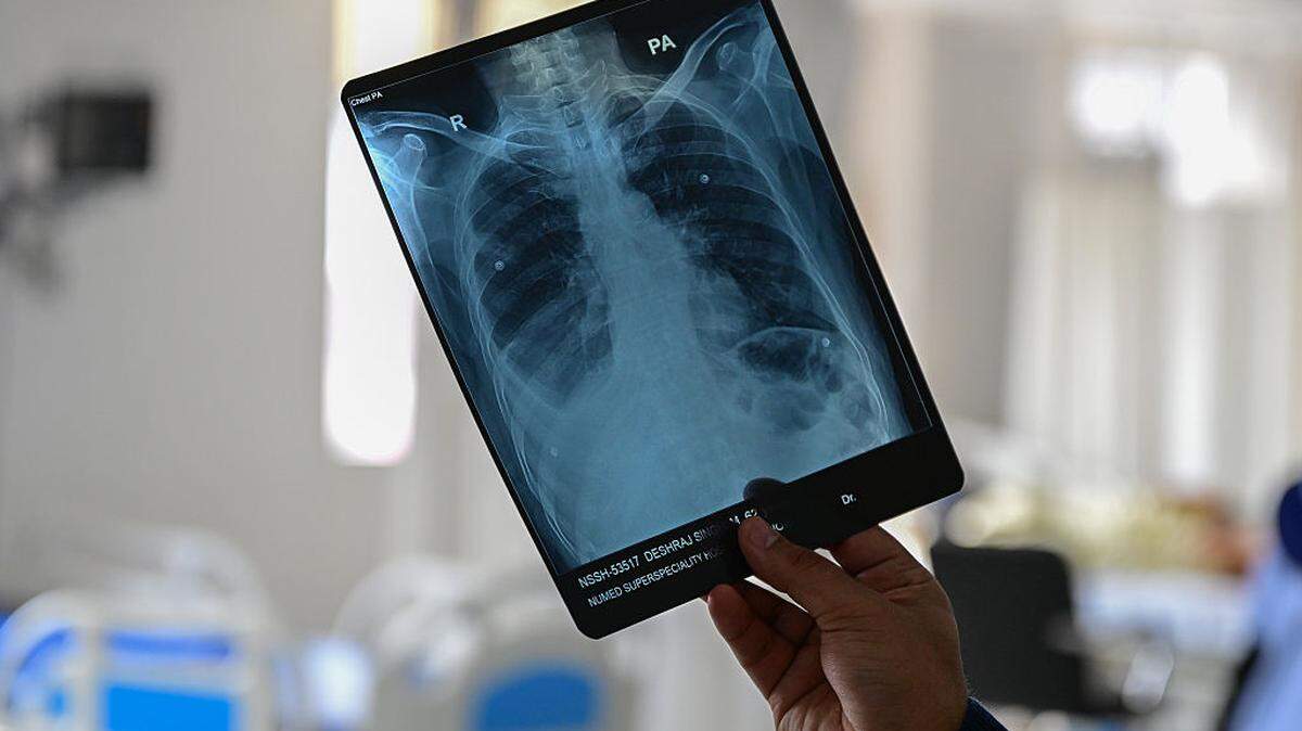 A new gene receptor and a Penn State prune trial are changing bone loss research. Here is what researchers say matters most for prevention.