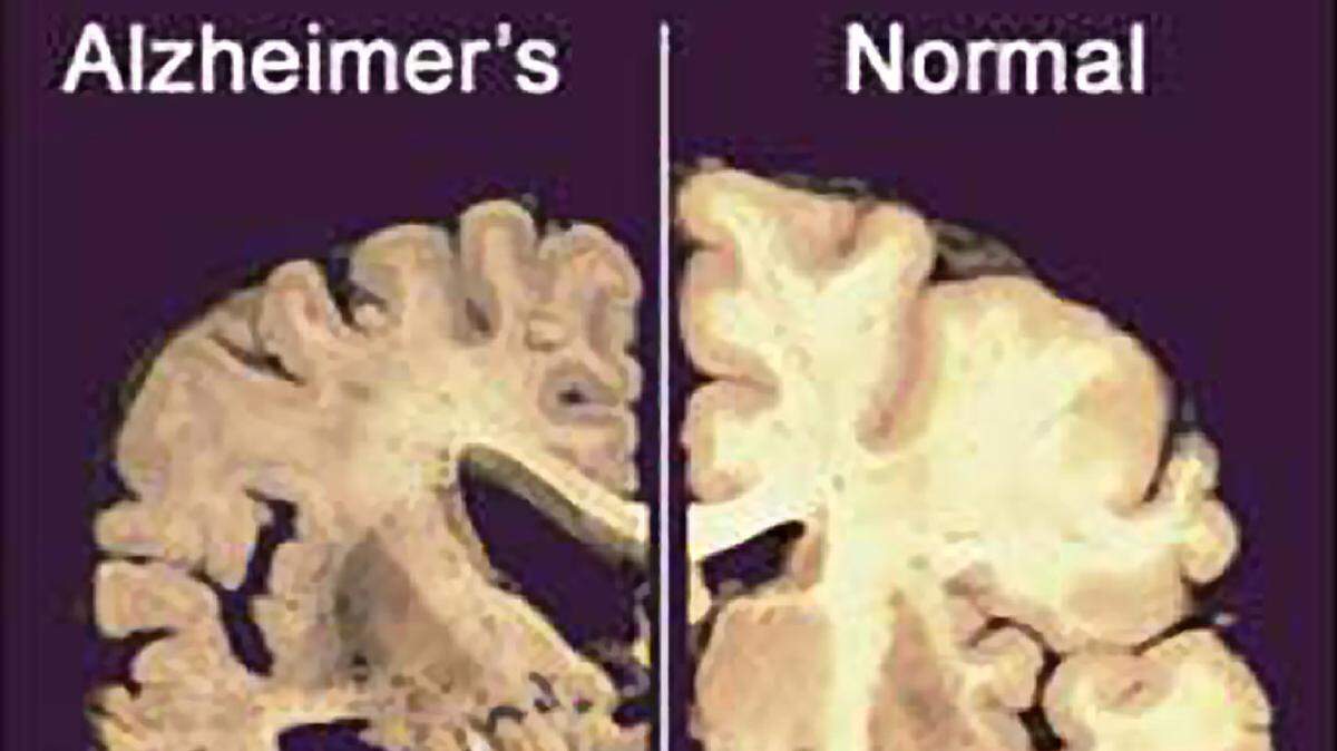 Know these 10 warning signs of Alzheimer’s Disease