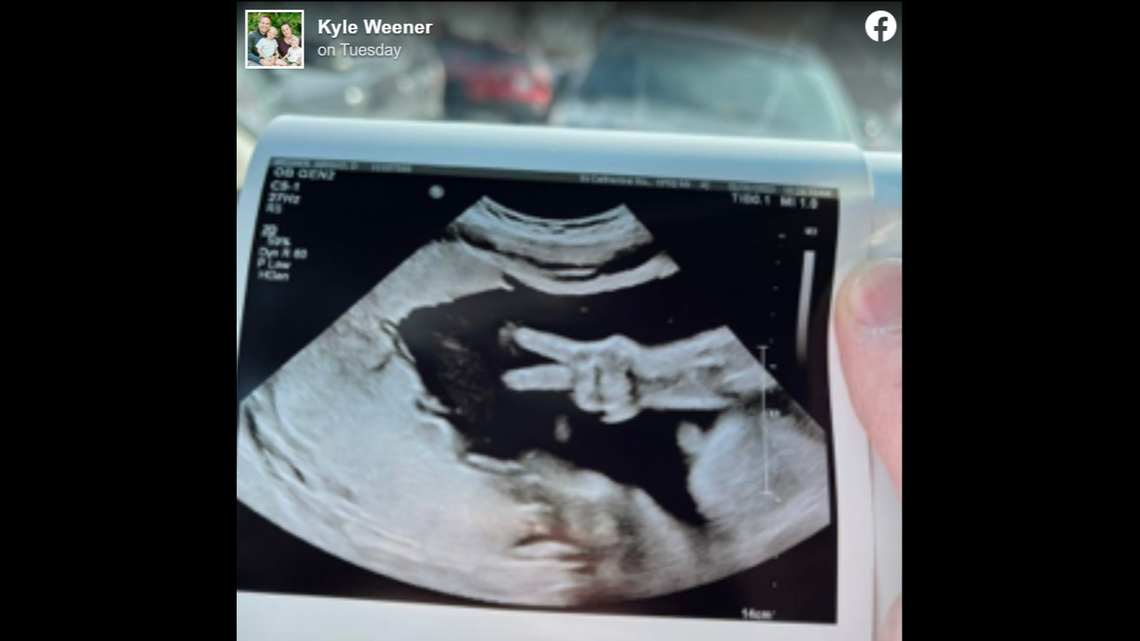 An unborn baby held up a “peace sign” during a recent ultrasound, her parents said.