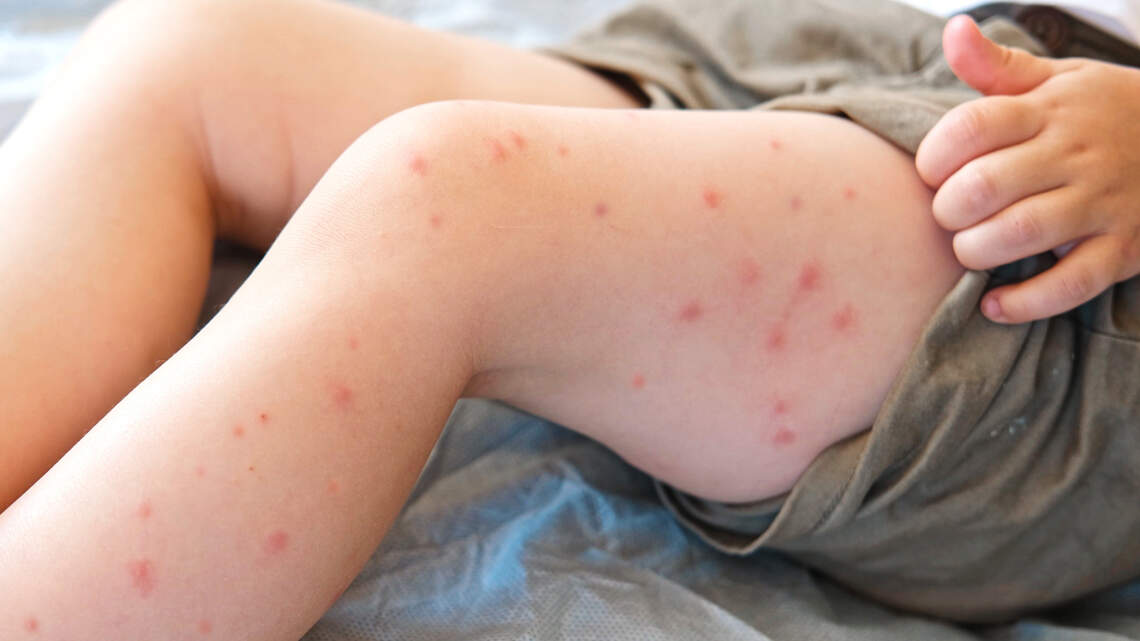 Missouri health agency warns of possible measles exposure at Sedalia train station