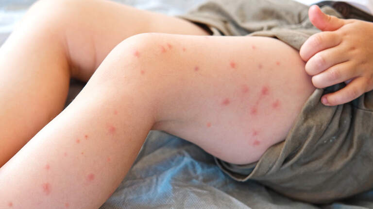 Measles case identified in Kansas City metro. Here are the exposure locations