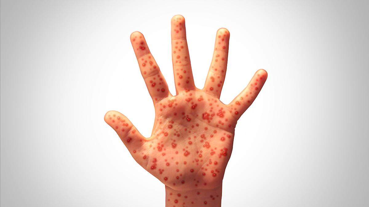 Contagious measles patient visited Grapevine in late March, Tarrant health officials say