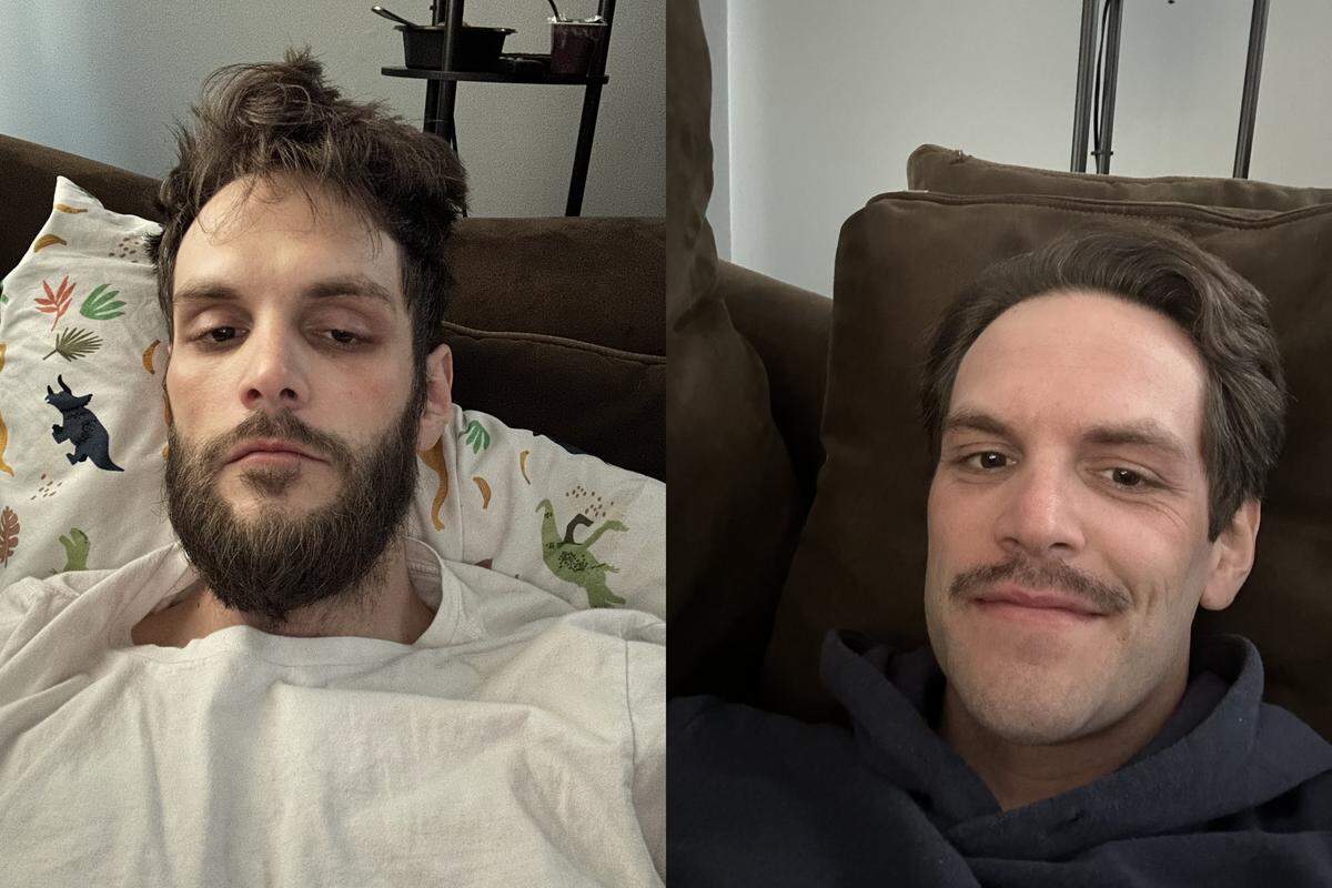 On the left, John Vernier during withdrawal from quitting 7-OH. On the right, Vernier four months clean.