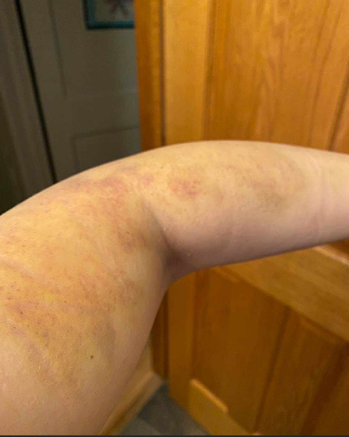 Patty Day said her arms were bruised as a result of excessive force used by Derek Chauvin and Ellen Jensen, according to a federal lawsuit filed May 21.