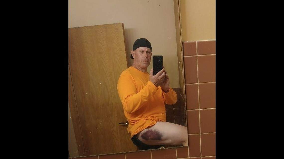 Gregg Goldstein was left with bruises along the left side of his body after the crash.