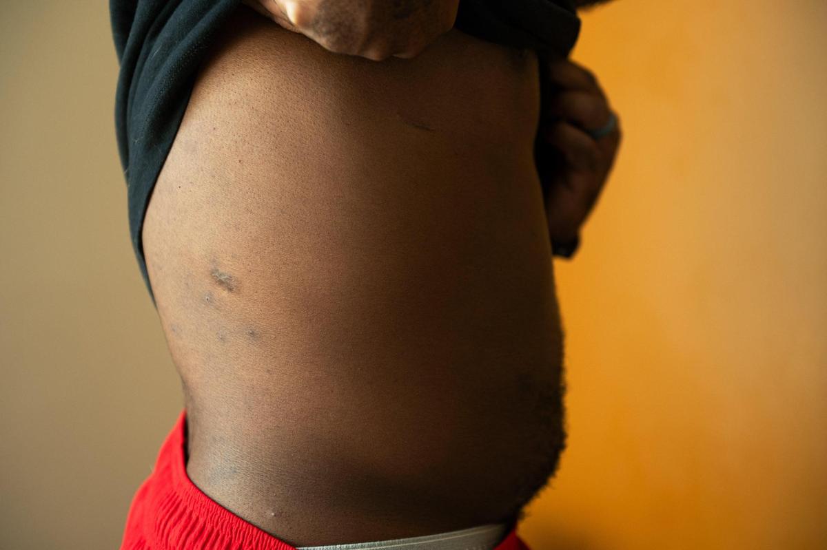 John Roddy lifts his shirt to show his bullet wounds at his home in Blue Springs.