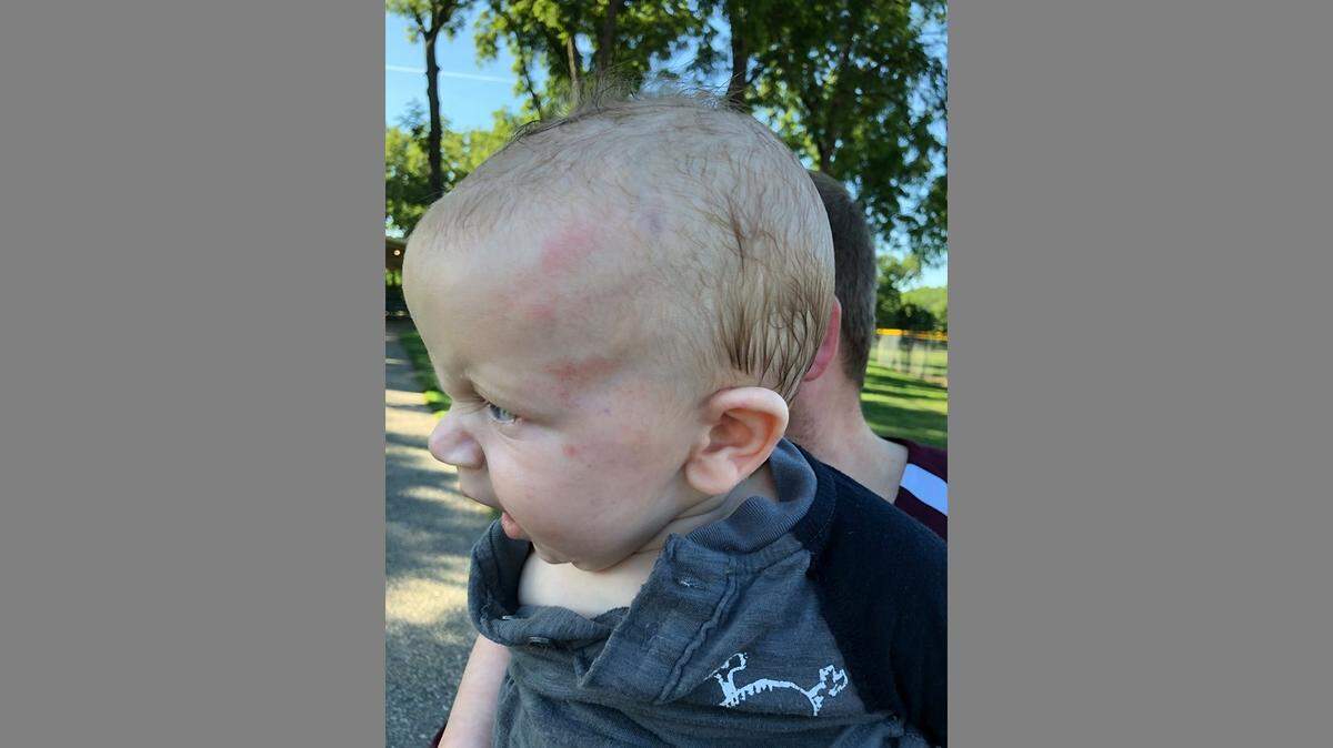 Glen Braun’s parents say he had red marks on his head when they picked him up from day care.