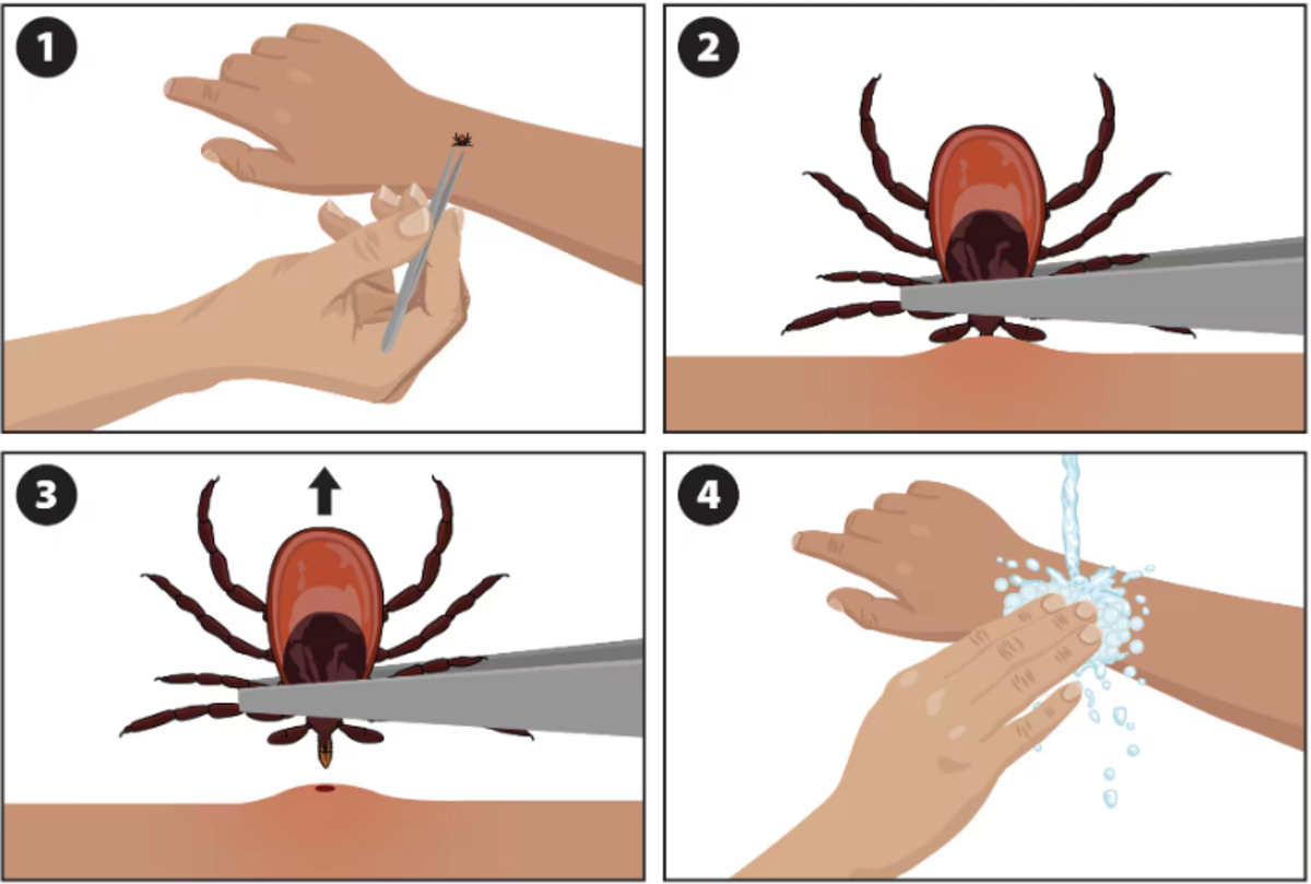 Use clean tweezers to remove a tick, and try to remove the insect’s mouth-parts. Screenshot of CDC graphic. June 26, 2024.