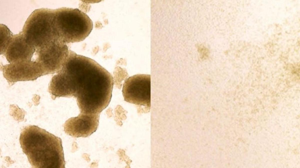 Brain cancer stem cells (left) are killed by Zika virus infection (image at right shows cells after Zika treatment). A new study shows that the virus, known for killing cells in the brains of developing fetuses, could be redirected to destroy the kind of brain cancer cells that are most likely to be resistant to treatment.