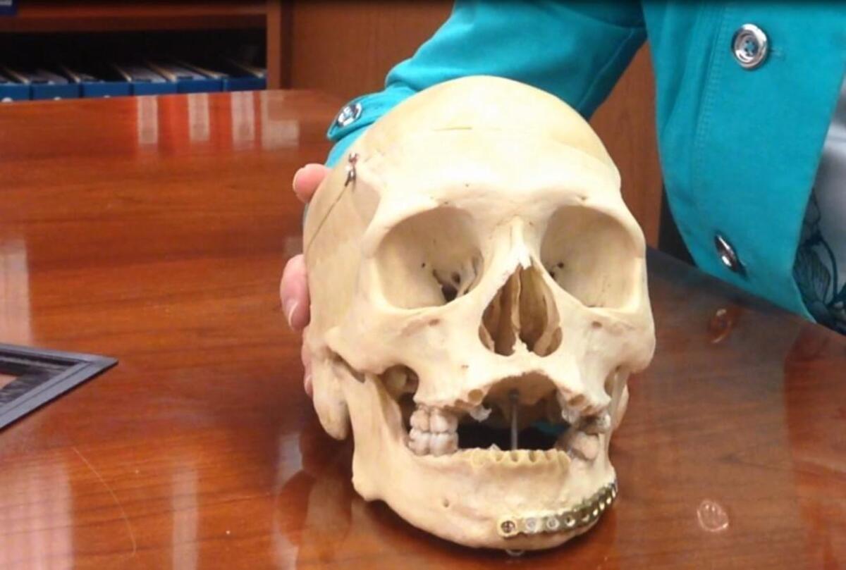 A skull with a metal plate attached to the jaw was part of set of human remains that sat unidentified for years until an investigator with the Jackson County Medical Examiner’s office cracked the case.
