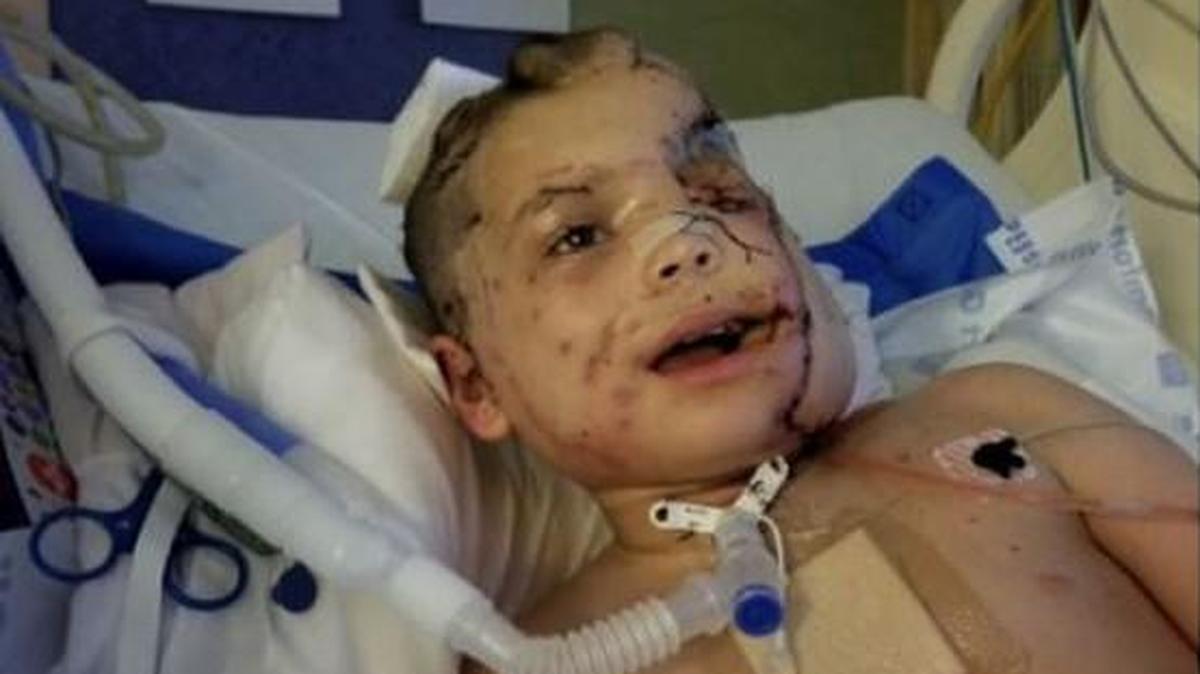 Chance Orozco, 10, survived an attack by a German shepherd last month. Now, he faces months of surgery, cannot speak and may lose vision in one eye. A fundraiser was created to help the boy’s family pay for medical expenses.