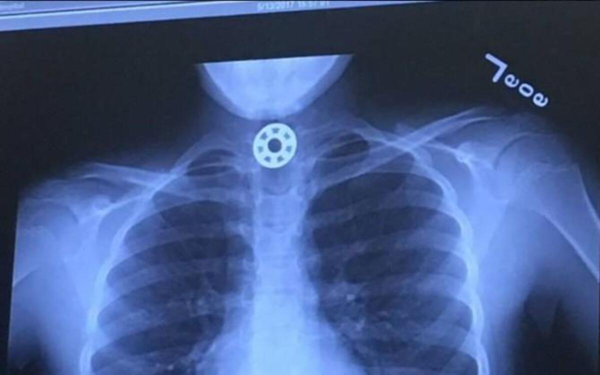 Houston area mom Kelly Rose Joniec posted this X-ray of a fidget spinner part lodged in her daughter’s throat.