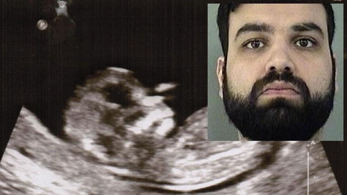Sikander Imran is accused of spiking his girlfriend’s tea with an abortion pill after she told him she didn’t want an abortion.