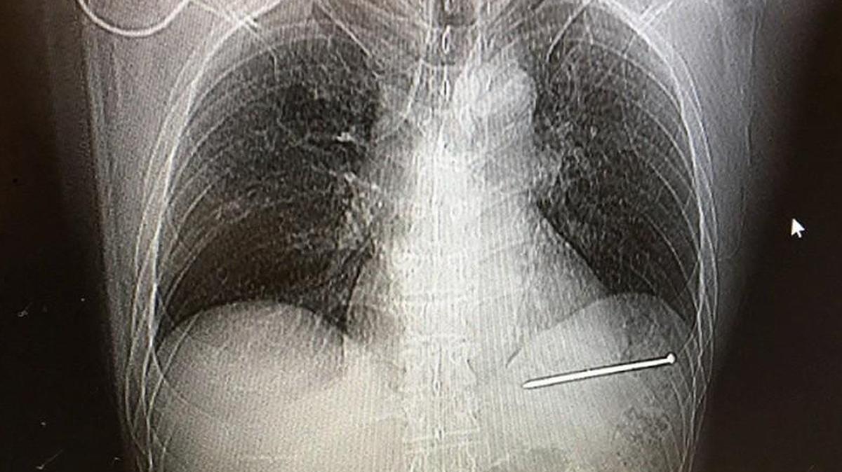 If Doug Bergeson of Peshtigo, Wisc. was a cat, he just used up one of his nine lives. Bergeson accidentally shot himself in the heart with a nail gun about seven weeks ago and lived to talk about it.