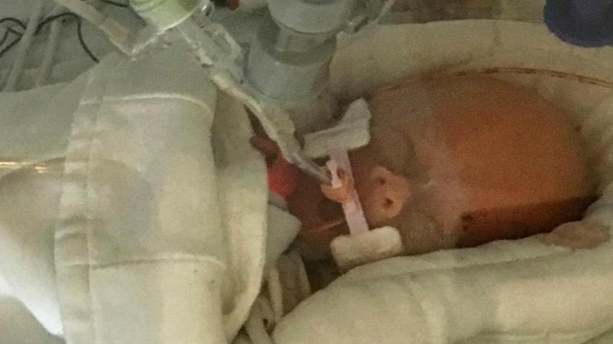 In this Sept. 8 photo provided by Sonya Nelson, Life Lynn DeKlyen lay in the Neonatal Intensive Care Unit of the University of Michigan Hospital in Ann Arbor, Mich.
