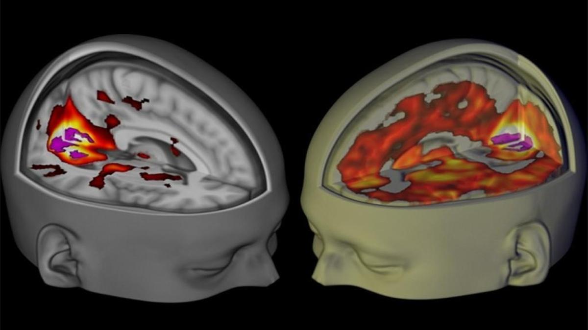 Under the influence of LSD, the brain's visual cortex has increased connectivity with other regions of the brain (right) than when under placebo (left).