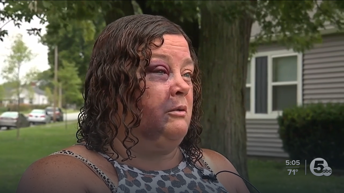 Akron woman, Tracy Corbin, was attacked at a bus stop on Aug. 5, she told news outlets.