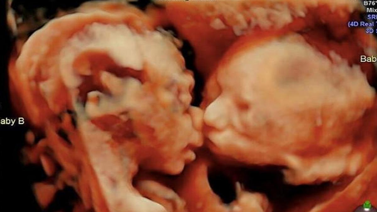 An ultrasound last week caught Carissa Gill’s twins kissing.