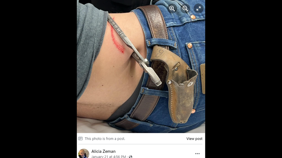 The pliers became “embedded” in bone, Zeman’s family says.