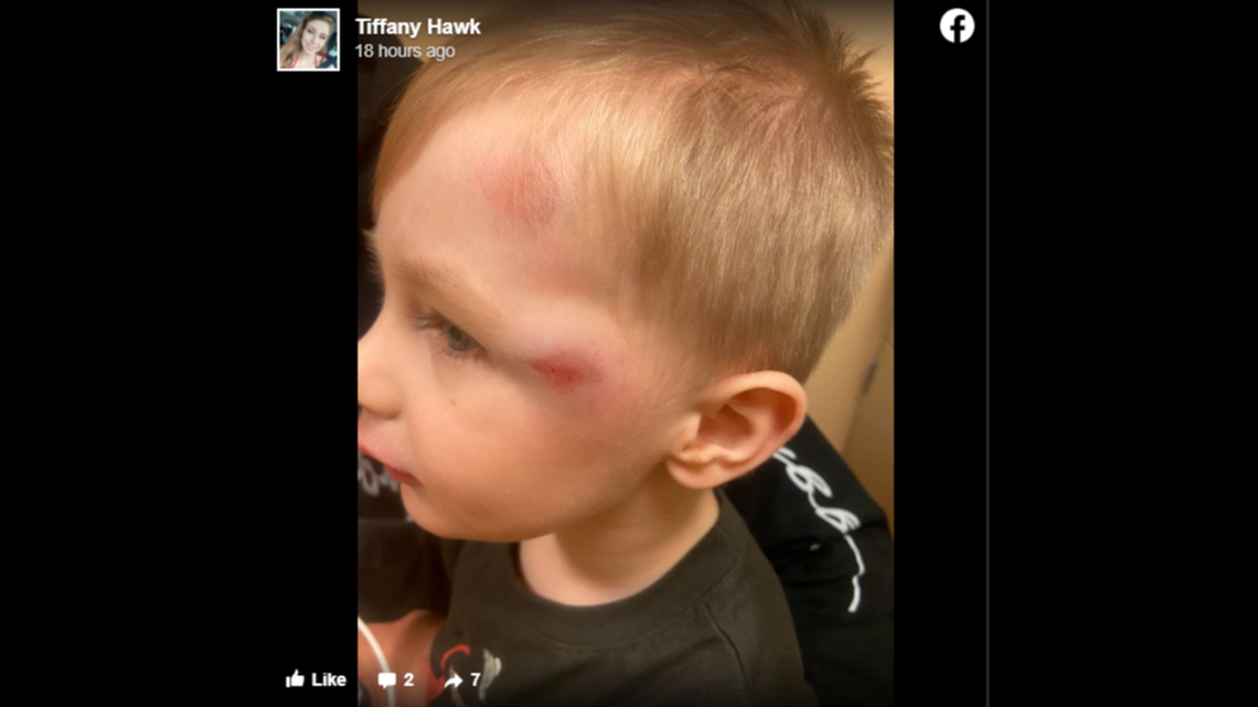 A 4-year-old boy is recovering after police say he was struck by an SUV while trick-or-treating on Halloween in Pennsylvania.