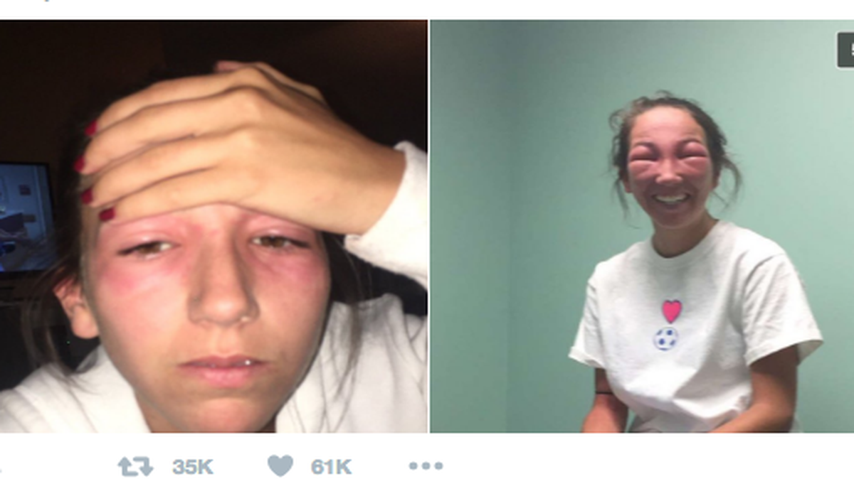 Poor Emily Petrozza. She got poison ivy in her eyes and the internet seriously freaked out.