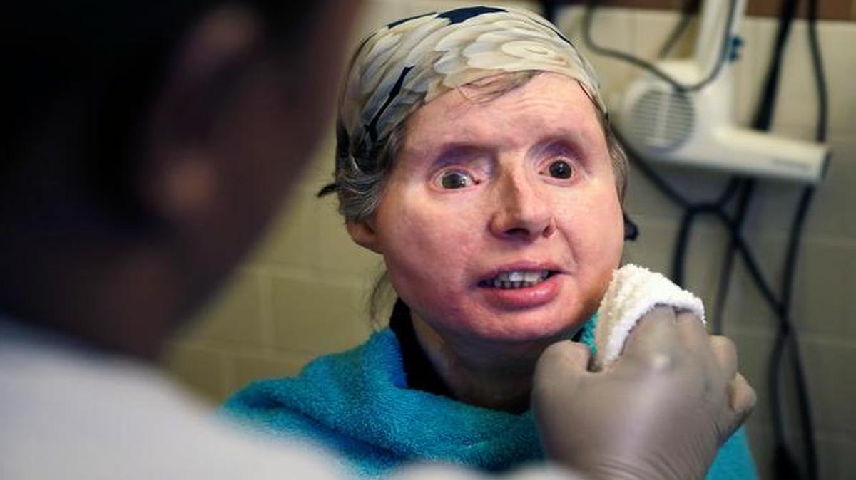 
Charla Nash smiled last month as her care worker washed her face at her apartment in Boston. The Department of Defense is following Nash’s progress after funding her transplant surgery in 2011. Nash lost her face, eyes and hands after being mauled by a chimpanzee in 2009. 
