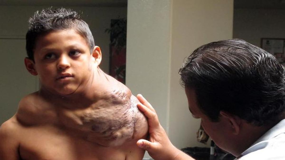 
In this July 20, 2012, file photo, the father of a Ciudad Juarez-born boy suffering from a massive tumor examined his shoulder at the First Baptist Church of Rio Rancho, N.M. 
