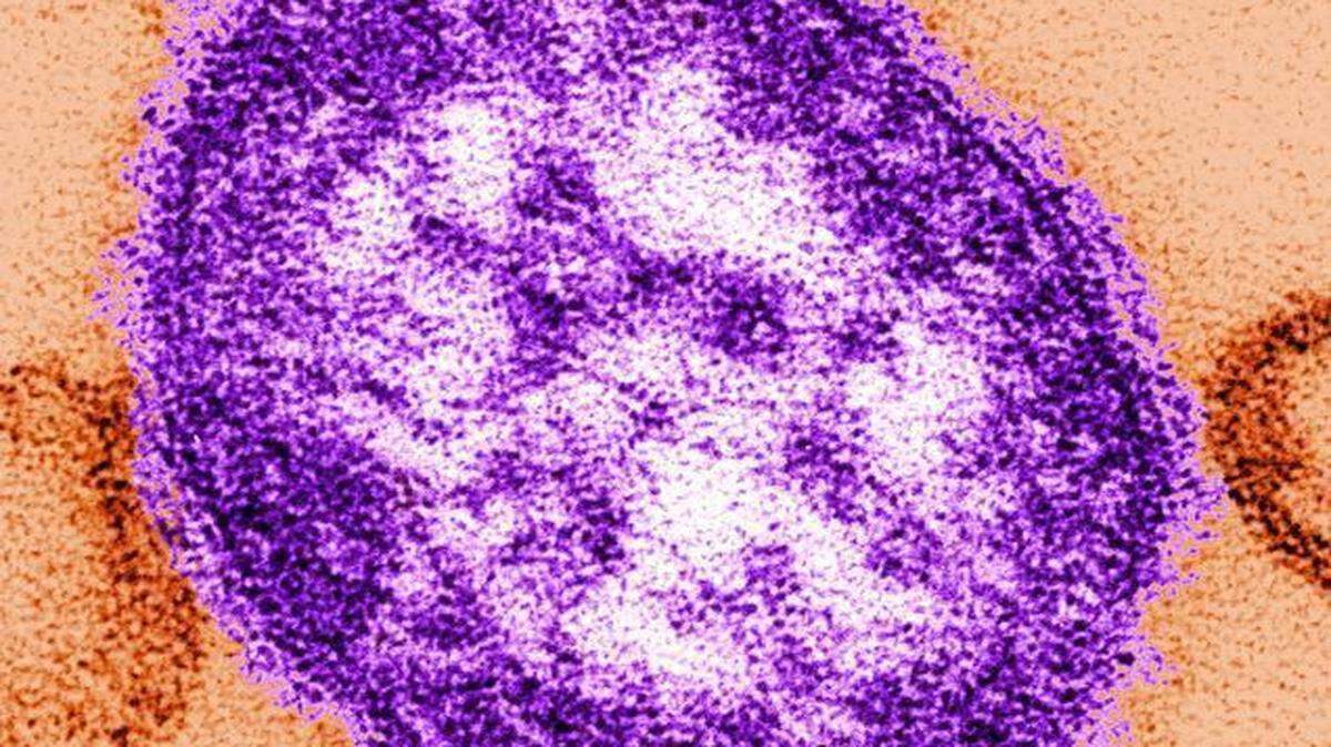 
This image made available by the Centers for Disease Control and Prevention shows an electron microscope image of a measles virus particle.
