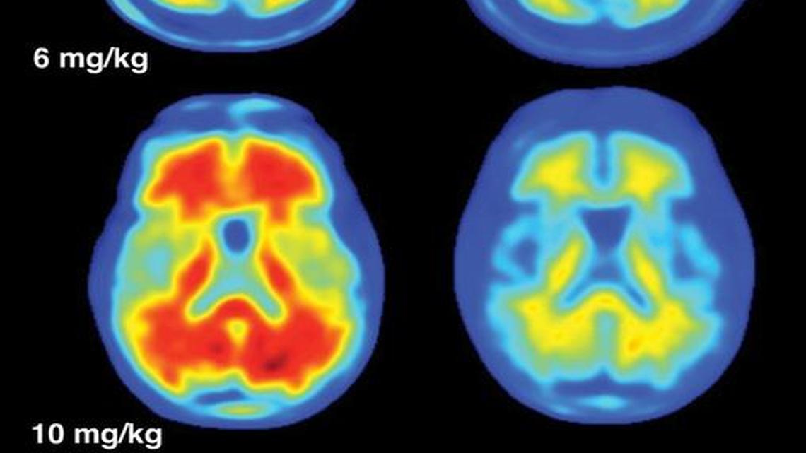 For those taking the highest doses of Biogen’s experimental drug aducanumab, a year of treatment reduced amyloid plaques, in red on the left, a hallmark of Alzheimer’s disease.