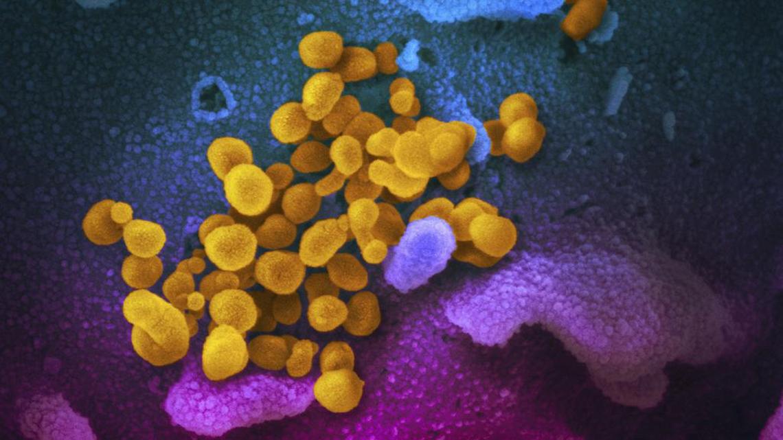 This undated electron microscope image made available by the U.S. National Institutes of Health in February 2020 shows the Novel Coronavirus SARS-CoV-2, yellow, emerging from the surface of cells, blue/pink, cultured in the lab. Also known as 2019-nCoV, the virus causes COVID-19. The sample was isolated from a patient in the U.S.