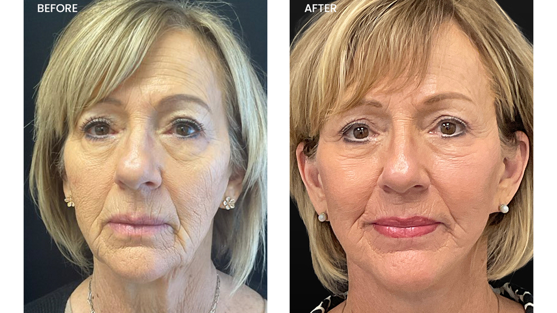 Who Does the Best Facelift in Oklahoma? 